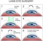 Laser Eye Surgery