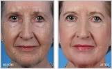 Laser Skin Resurfacing