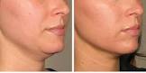 Laser Skin Tightening Services