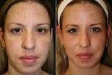 Laser Skin Treatment