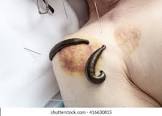 Leech Therapy