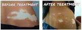 Leucoderma Treatment Services