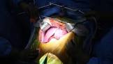 Liver Surgery