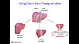 Liver Transplantation