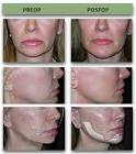 Mandible Implants