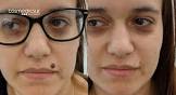 Mole Removal