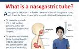 Nasogastric Tube