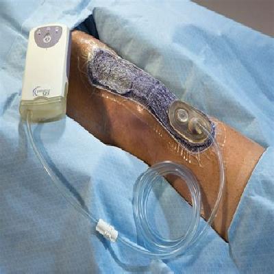 Negative Pressure Wound Therapy