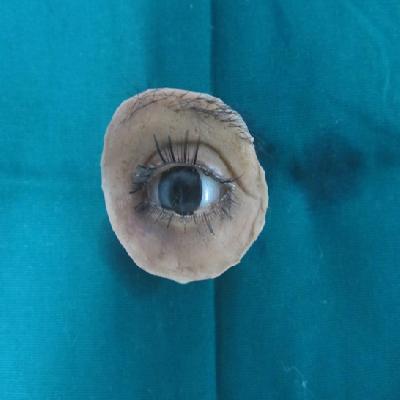Orbital Prosthesis 