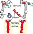Orthopedic Locking Plates