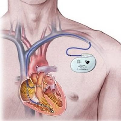 Pacemaker Surgery 