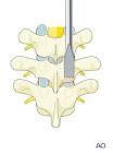 Pedicle Hooks
