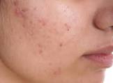 Pimples Treatment