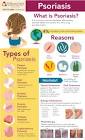 Psoriasis Treatment Services
