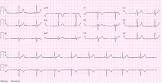 Resting Ecg