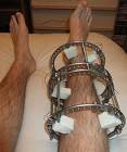 Ring Fixator