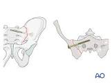 Sacral Screw