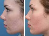 Scar Treatment