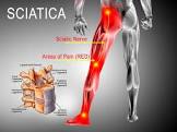 Sciatica Treatment