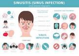 Sinusitis Treatment