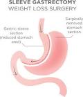 Sleeve Gastric Surgery