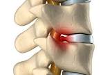Slipped Disc Treatment Services