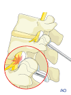 Spinal Hook
