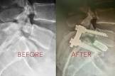 Spinal Implants