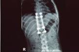 Spine Rod