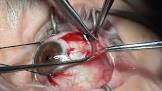 Squint Surgery