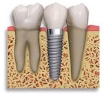 Surgical Implants