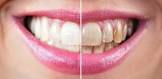 Teeth Whitening