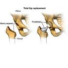Total Hip Replacement Services