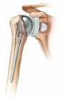 Total Shoulder Replacement