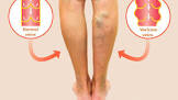 Varicose Veins Treatment