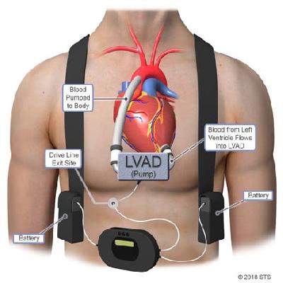Ventricular Assist Device