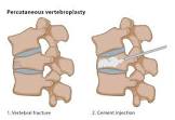 Vertebroplasty