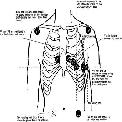 ECG ELECTRODES
