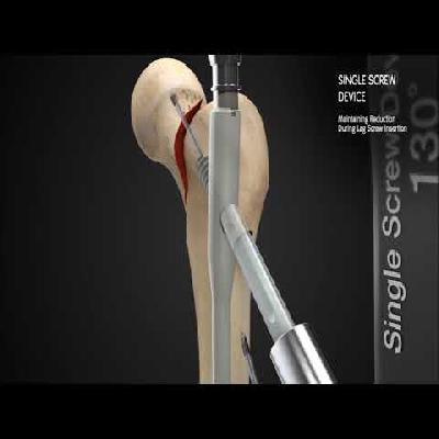 Trigen Trochanteric Antegrade Nail