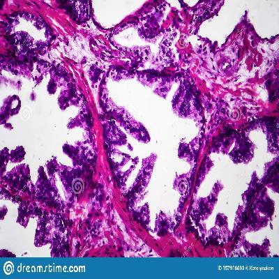 Benign Prostatic Hypertrophy Pathology Model