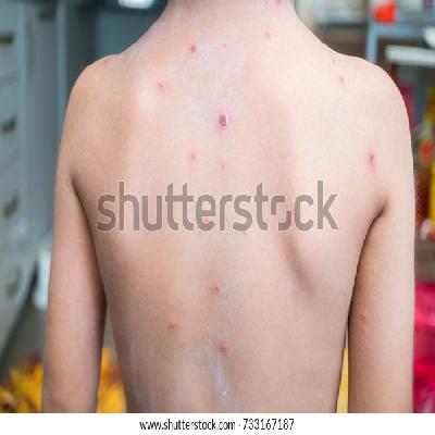 Chicken Pox Model Showing 