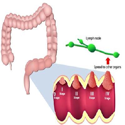 Colon Cancer Pathology Model