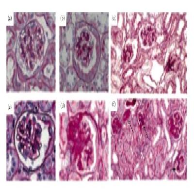 Diabetic Nephropathy Pathology Model