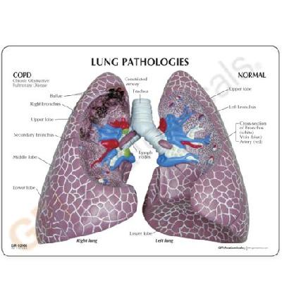 Lung Cancer Model