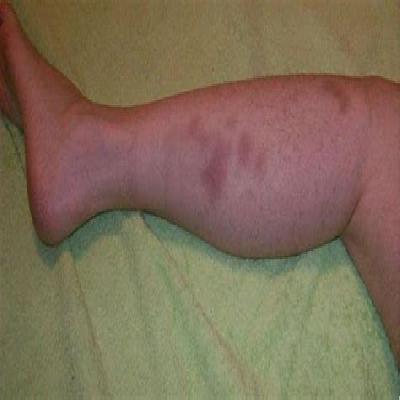 Multiple Bruises On Foot Forensic Models