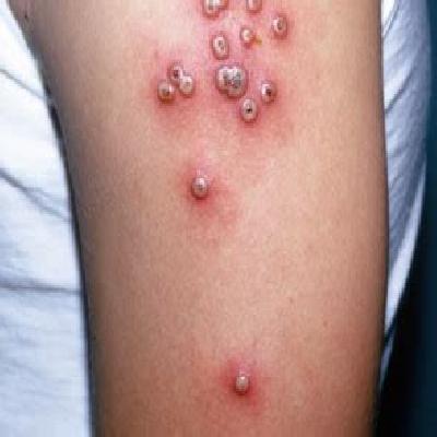Small Pox Pustules Human Anatomical Models