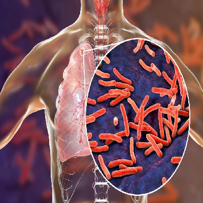 Tuberculosis model showing (causes, symptoms,Treatment , Prevention.)