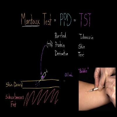 Arkray Mantoux Test PPD 10 Tu