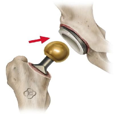 Hip Joints