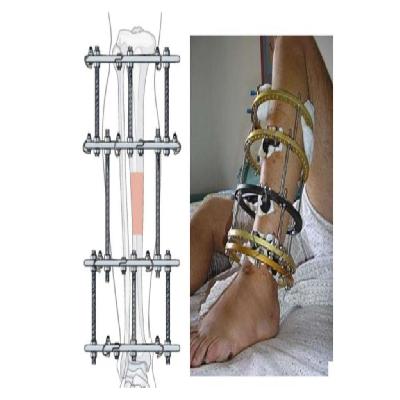 Ilizarov External Ring Fixator